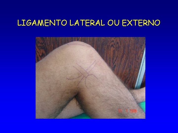 LIGAMENTO LATERAL OU EXTERNO 