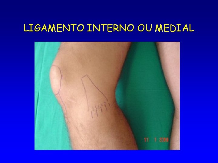 LIGAMENTO INTERNO OU MEDIAL 