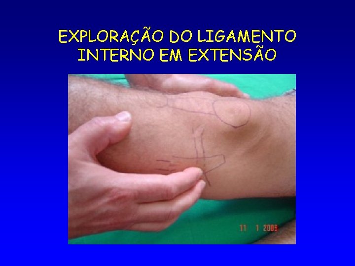 EXPLORAÇÃO DO LIGAMENTO INTERNO EM EXTENSÃO 