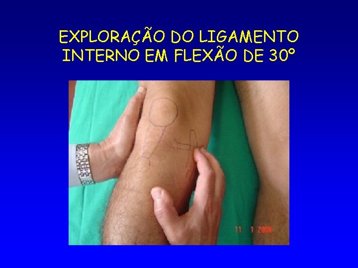 EXPLORAÇÃO DO LIGAMENTO INTERNO EM FLEXÃO DE 30º 