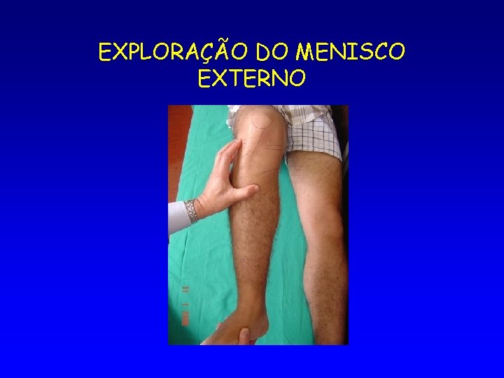 EXPLORAÇÃO DO MENISCO EXTERNO 