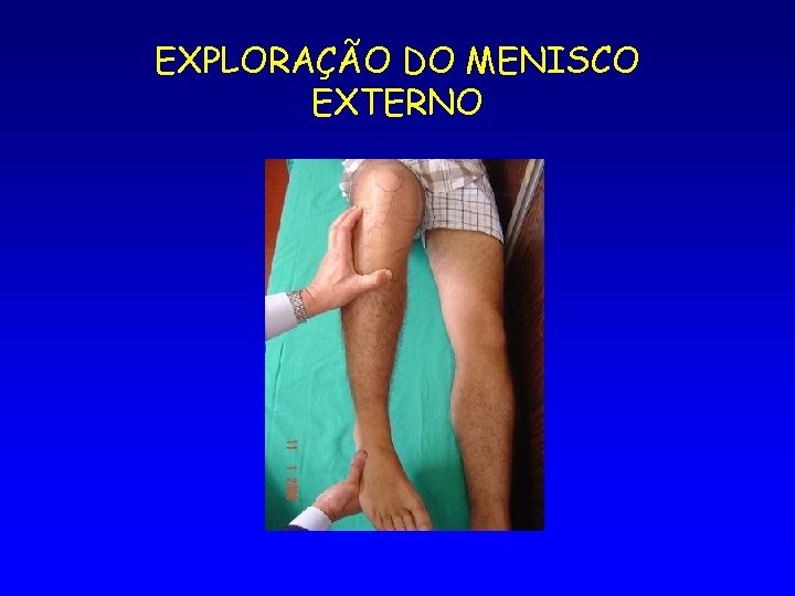 EXPLORAÇÃO DO MENISCO EXTERNO 