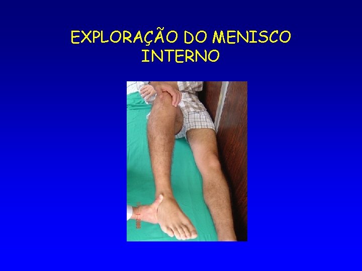 EXPLORAÇÃO DO MENISCO INTERNO 