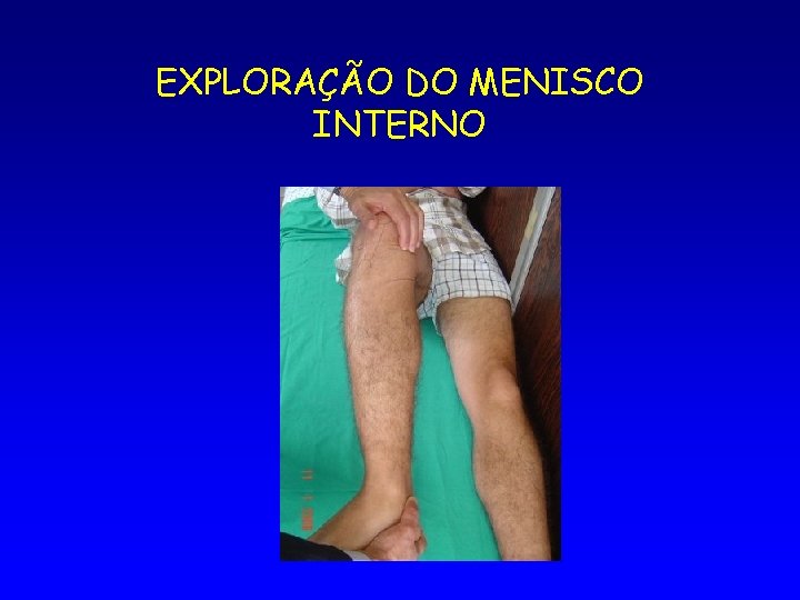 EXPLORAÇÃO DO MENISCO INTERNO 