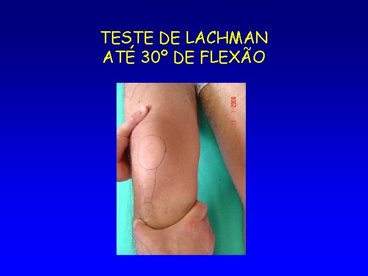 TESTE DE LACHMAN ATÉ 30º DE FLEXÃO 
