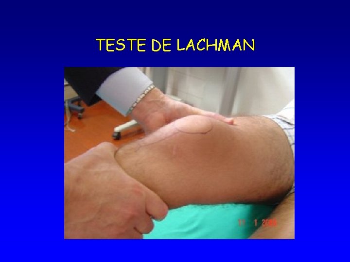 TESTE DE LACHMAN 