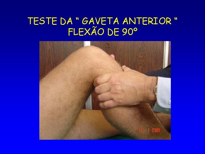 TESTE DA “ GAVETA ANTERIOR “ FLEXÃO DE 90º 
