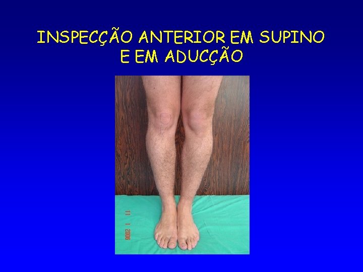 INSPECÇÃO ANTERIOR EM SUPINO E EM ADUCÇÃO 