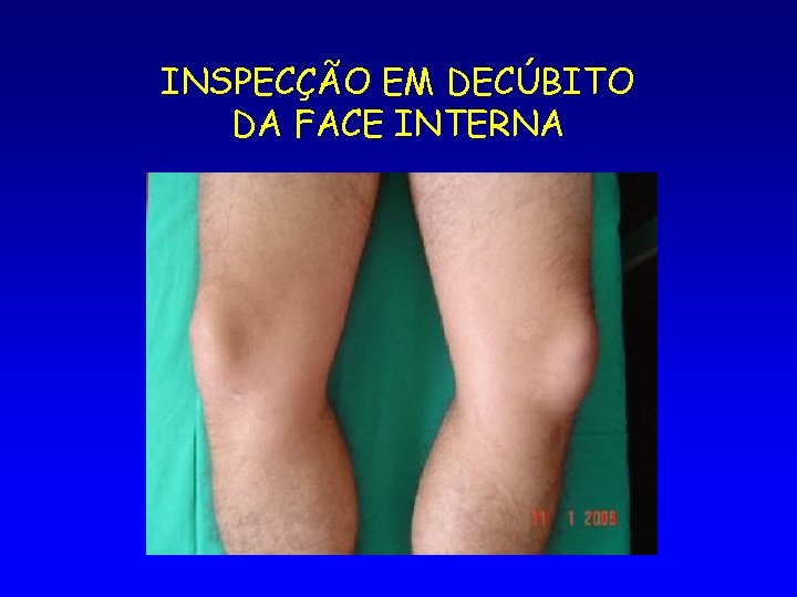 INSPECÇÃO EM DECÚBITO DA FACE INTERNA 