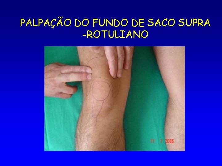 PALPAÇÃO DO FUNDO DE SACO SUPRA -ROTULIANO 