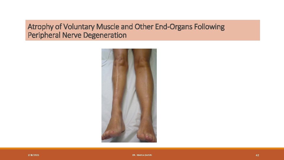 Atrophy of Voluntary Muscle and Other End-Organs Following Peripheral Nerve Degeneration 2/28/2021 DR. MARIA