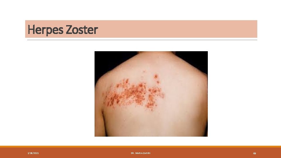 Herpes Zoster 2/28/2021 DR. MARIA ZAHIRI 49 