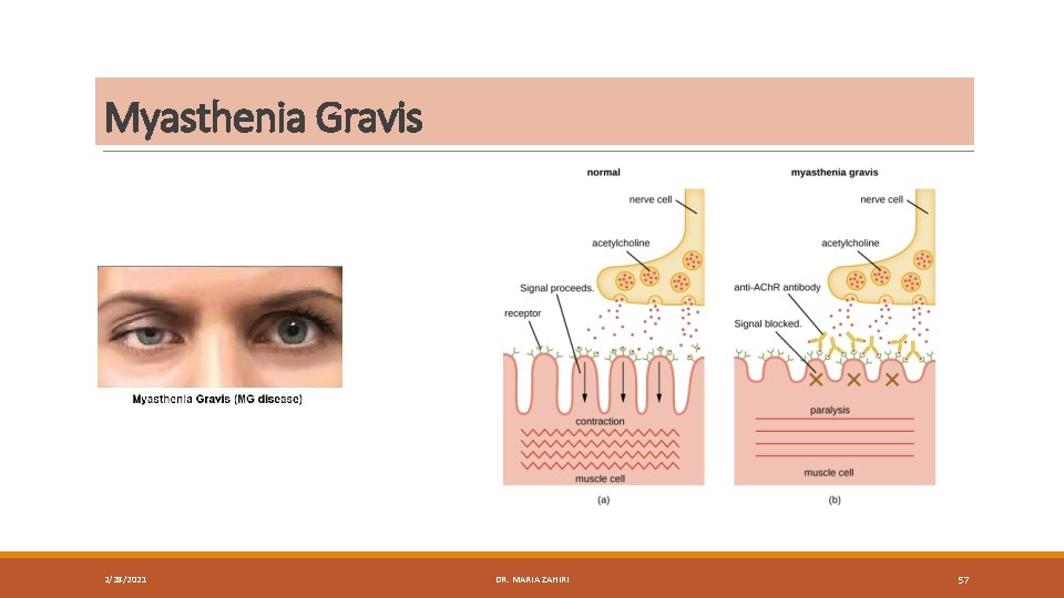 Myasthenia Gravis 2/28/2021 DR. MARIA ZAHIRI 57 
