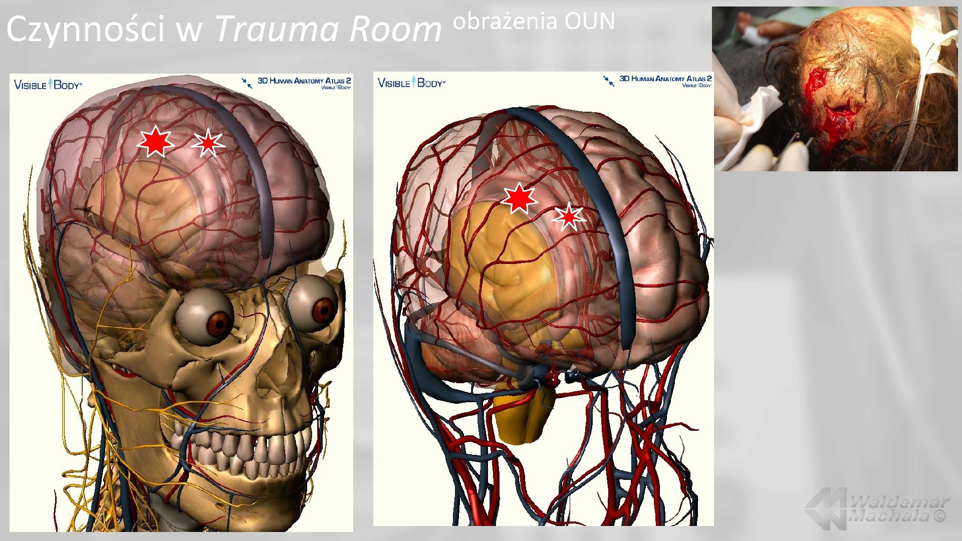 Czynności w Trauma Room obrażenia OUN 