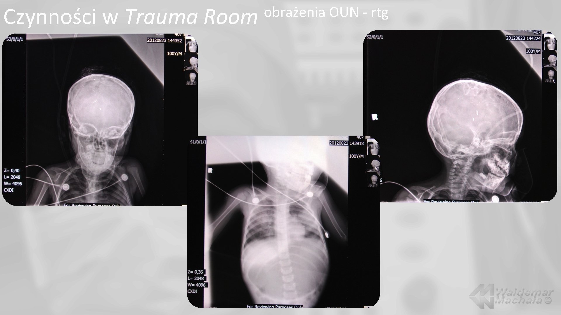 Czynności w Trauma Room obrażenia OUN - rtg 