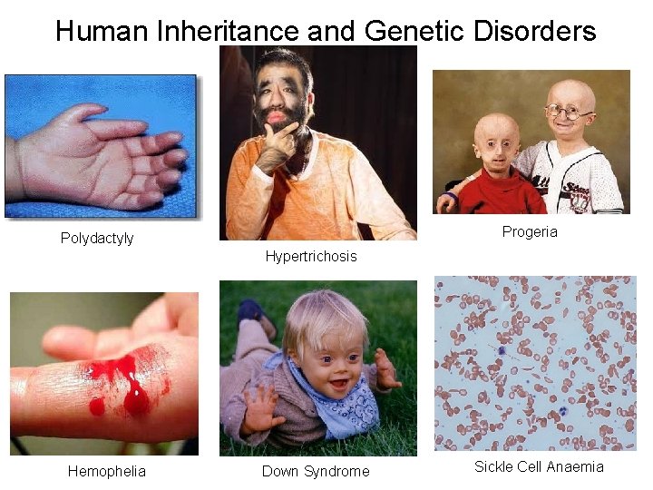 Human Inheritance and Genetic Disorders Progeria Polydactyly Hypertrichosis Hemophelia Down Syndrome Sickle Cell Anaemia