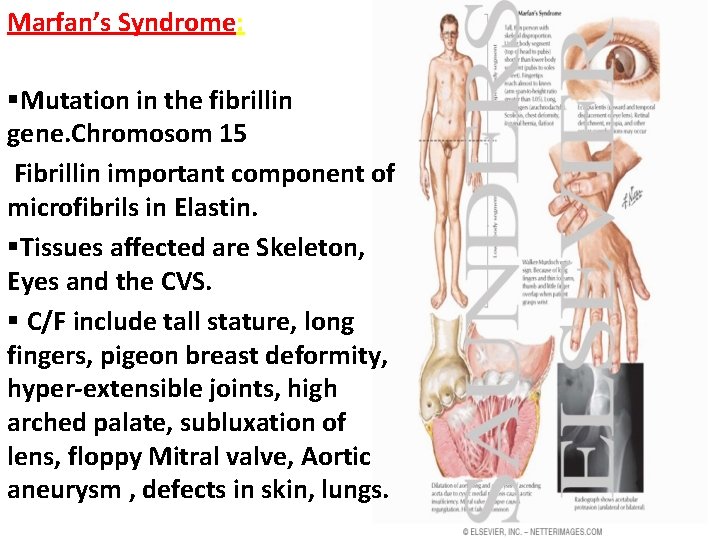 Marfan’s Syndrome: §Mutation in the fibrillin gene. Chromosom 15 Fibrillin important component of microfibrils