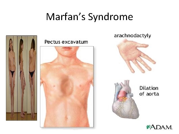 Marfan’s Syndrome Marfan’s Syndrome