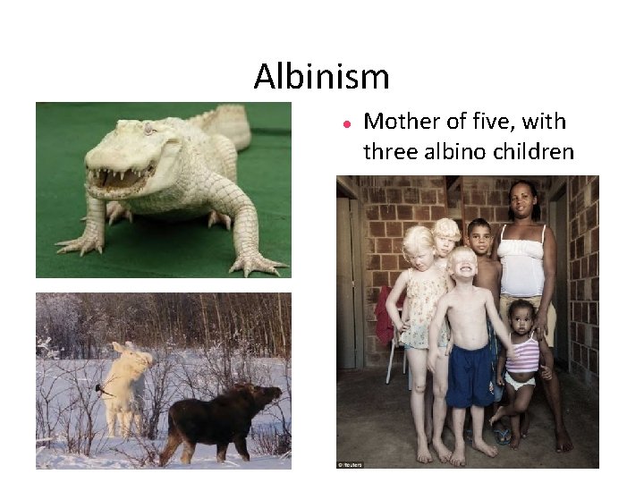 Albinism Mother of five, with three albino children 