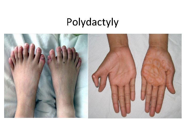 Polydactyly 