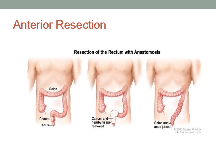 Anterior Resection 