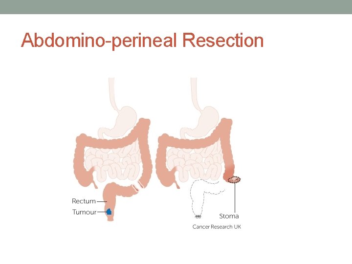 Abdomino-perineal Resection 