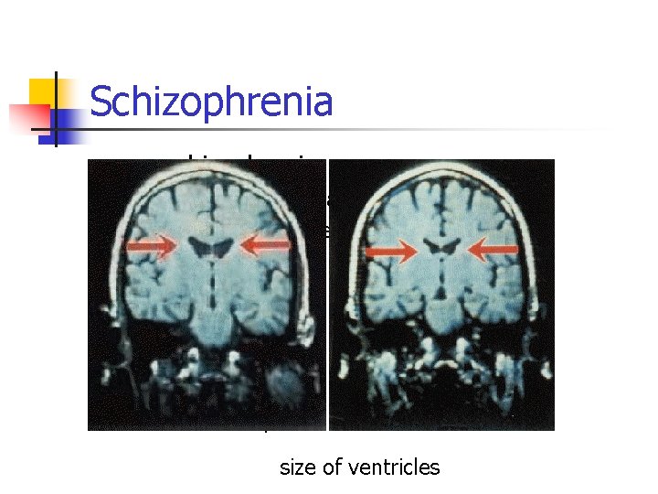 Schizophrenia schizophrenia n n n n n Clinical Manifestations Characteristics-- perturbations affecting: language perception