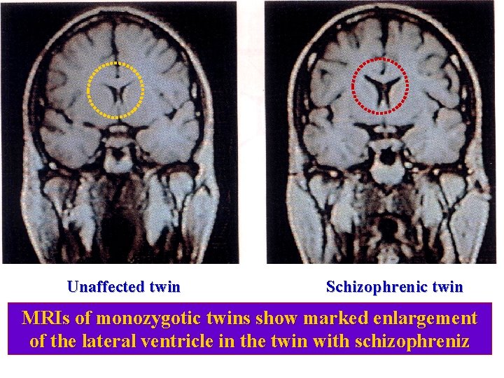 Unaffected twin Schizophrenic twin MRIs of monozygotic twins show marked enlargement of the lateral