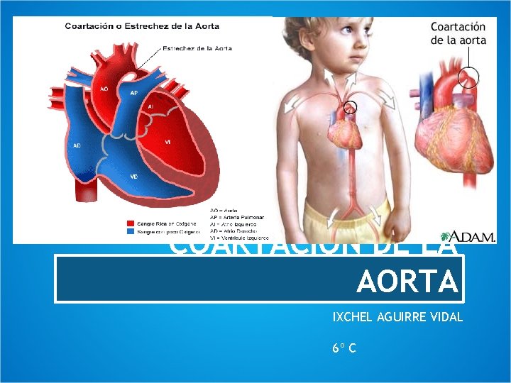 COARTACIÓN DE LA AORTA IXCHEL AGUIRRE VIDAL 6º C 