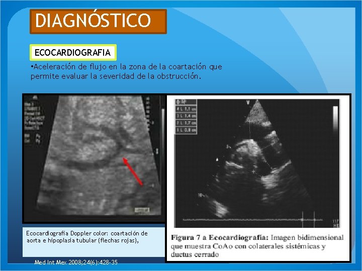 DIAGNÓSTICO ECOCARDIOGRAFIA • Aceleración de flujo en la zona de la coartación que permite