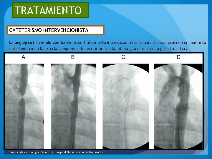 TRATAMIENTO CATETERISMO INTERVENCIONISTA La angioplastia simple con balón es un tratamiento intrínsecamente traumático que