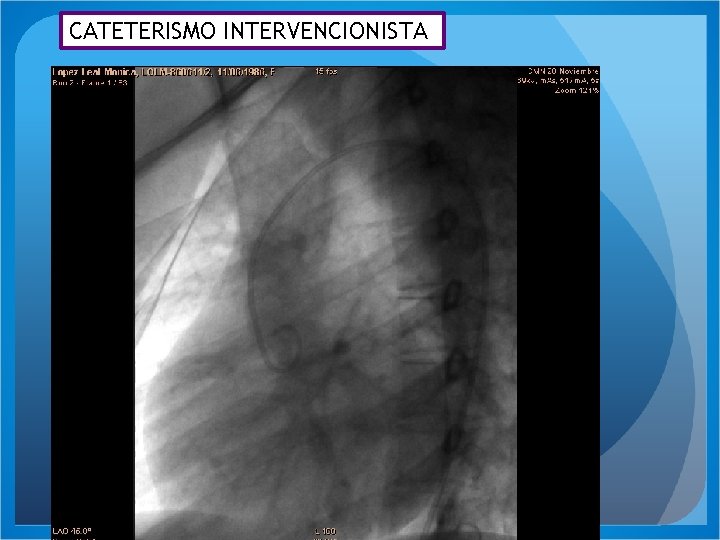 CATETERISMO INTERVENCIONISTA VIDEO 