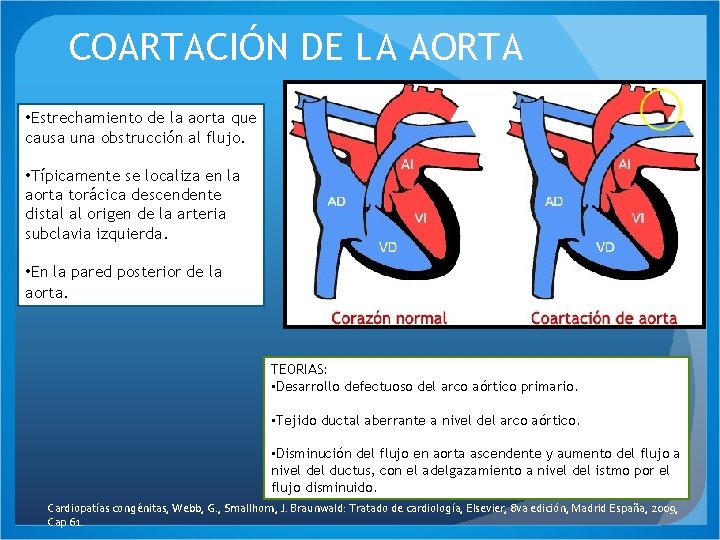 COARTACIÓN DE LA AORTA • Estrechamiento de la aorta que causa una obstrucción al