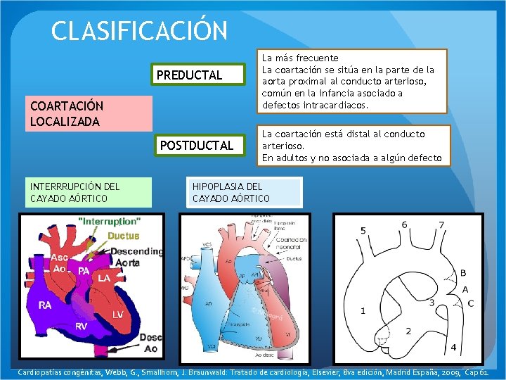 CLASIFICACIÓN PREDUCTAL COARTACIÓN LOCALIZADA POSTDUCTAL INTERRRUPCIÓN DEL CAYADO AÓRTICO La más frecuente La coartación