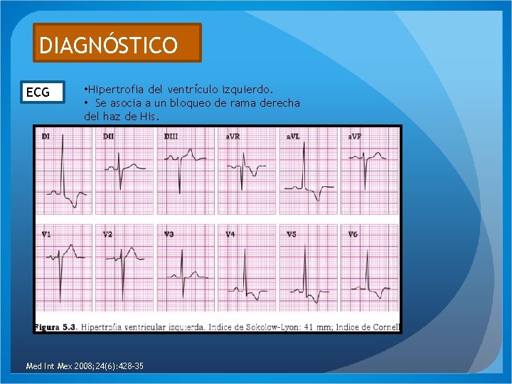 DIAGNÓSTICO ECG • Hipertrofia del ventrículo izquierdo. • Se asocia a un bloqueo de