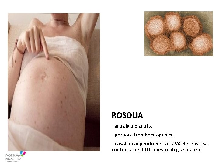 ROSOLIA - artralgia o artrite - porpora trombocitopenica - rosolia congenita nel 20 -25%