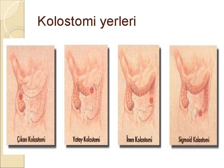 Kolostomi yerleri Kolostomi yerleri