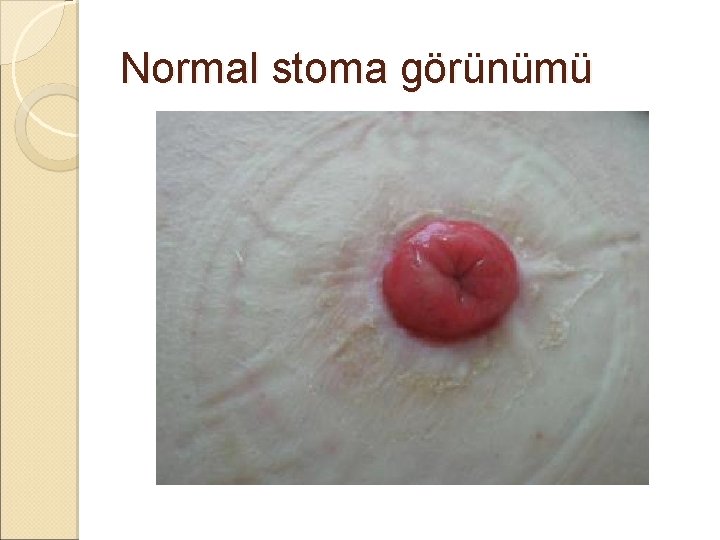 Normal stoma görünümü Normal stoma görünümü