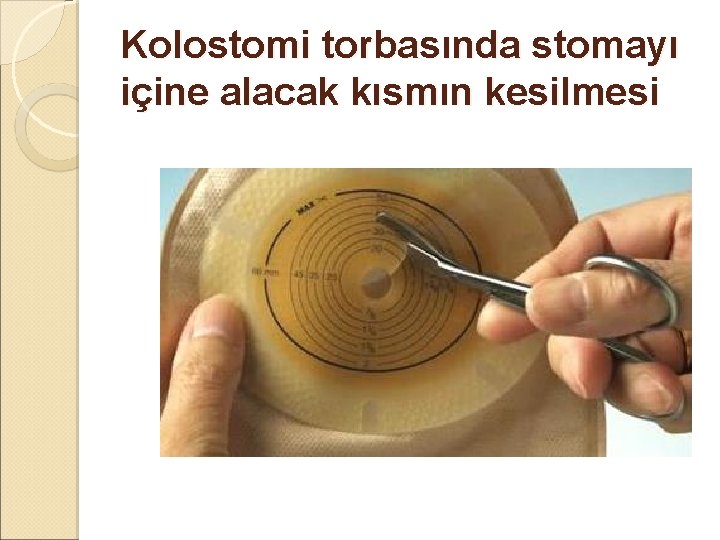 Kolostomi torbasında stomayı içine alacak kısmın kesilmesi Kolostomi torbasında stomayı içine alacak kısmın kesilmesi