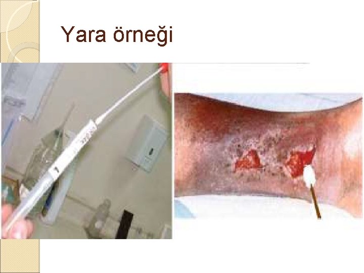 Yara örneği Yara örneği