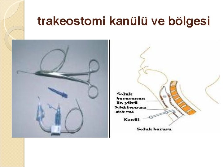 trakeostomi kanülü ve bölgesi trakeostomi kanülü ve bölgesi