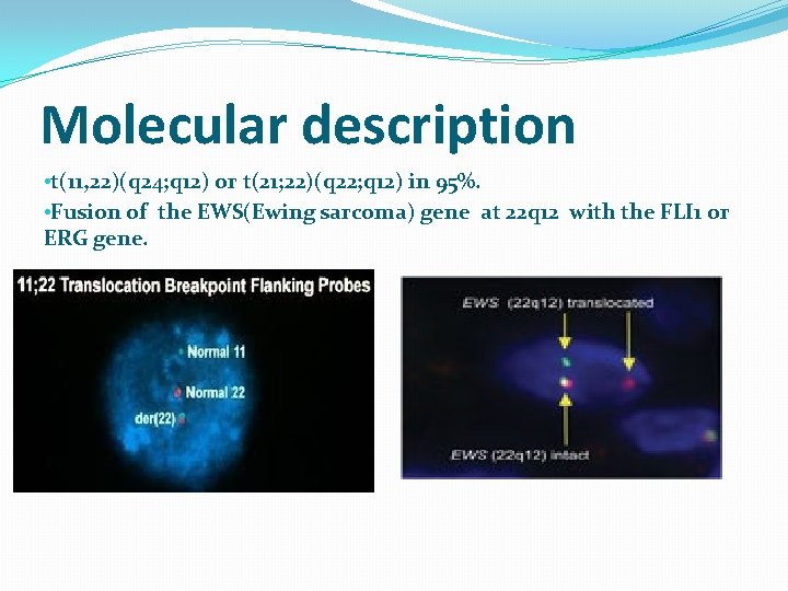 Molecular description • t(11, 22)(q 24; q 12) or t(21; 22)(q 22; q 12)