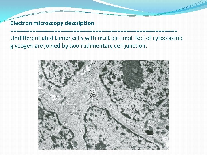 Electron microscopy description =========================== Undifferentiated tumor cells with multiple small foci of cytoplasmic glycogen