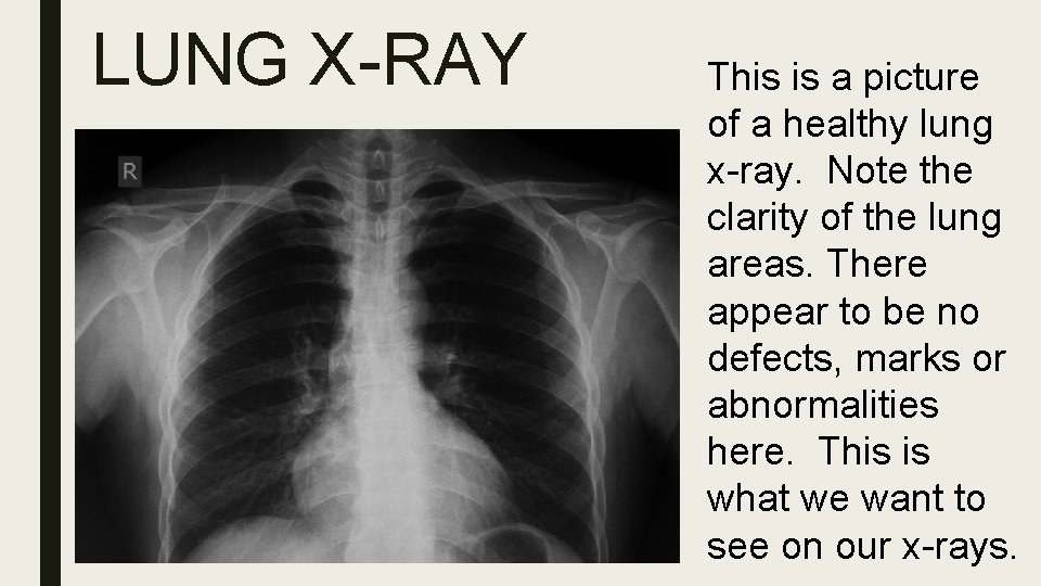 LUNG X-RAY This is a picture of a healthy lung x-ray. Note the clarity
