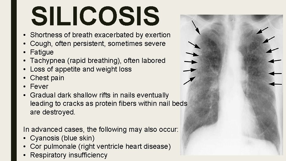  • • SILICOSIS Shortness of breath exacerbated by exertion Cough, often persistent, sometimes
