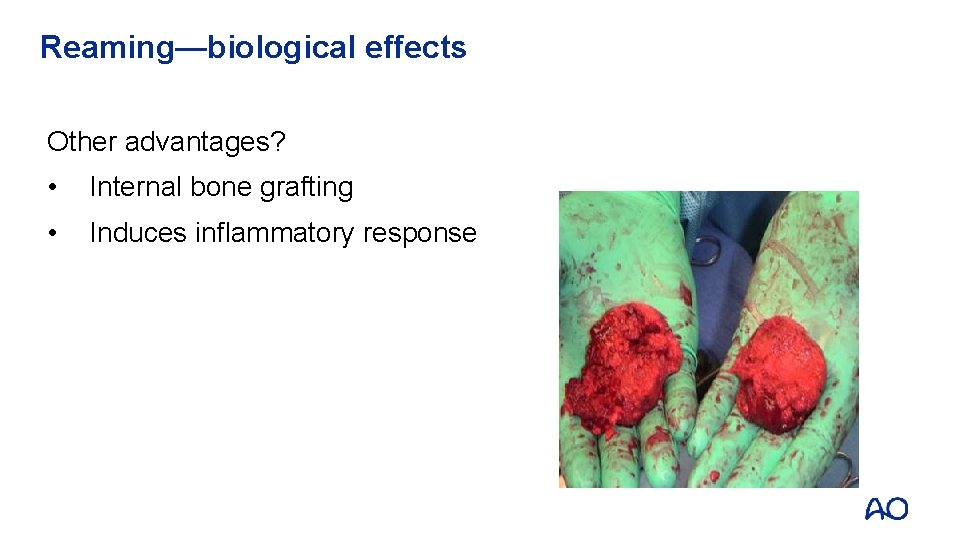 Reaming—biological effects Other advantages? • Internal bone grafting • Induces inflammatory response 