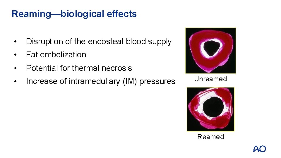 Reaming—biological effects • Disruption of the endosteal blood supply • Fat embolization • Potential