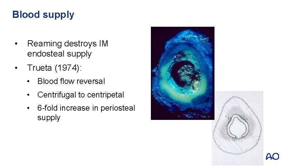 Blood supply • Reaming destroys IM endosteal supply • Trueta (1974): • Blood flow