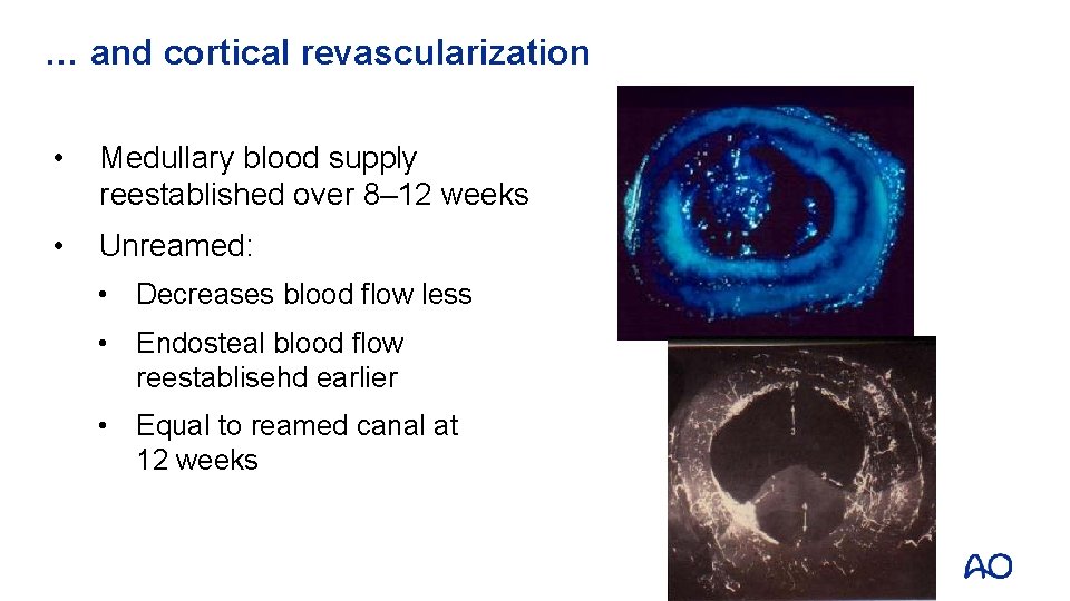 … and cortical revascularization • Medullary blood supply reestablished over 8– 12 weeks •