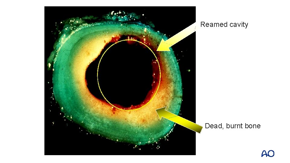 Reamed cavity Dead, burnt bone 